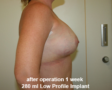 plastic-surgery-breast-augmentation
